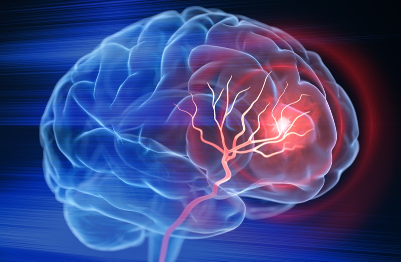 Keck Medicine of USC preview: stem cell transplant for stroke